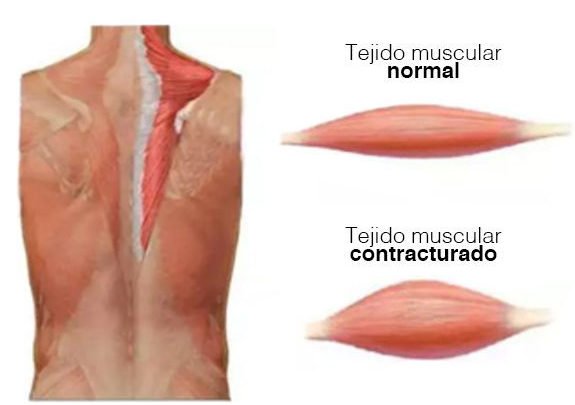 Técnicas de Masaje para Aliviar la Sobrecarga Muscular en la Espalda